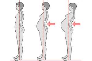 Imagen ilustrativa del artículo Tratamiento de la Lumbalgia en el Embarazo